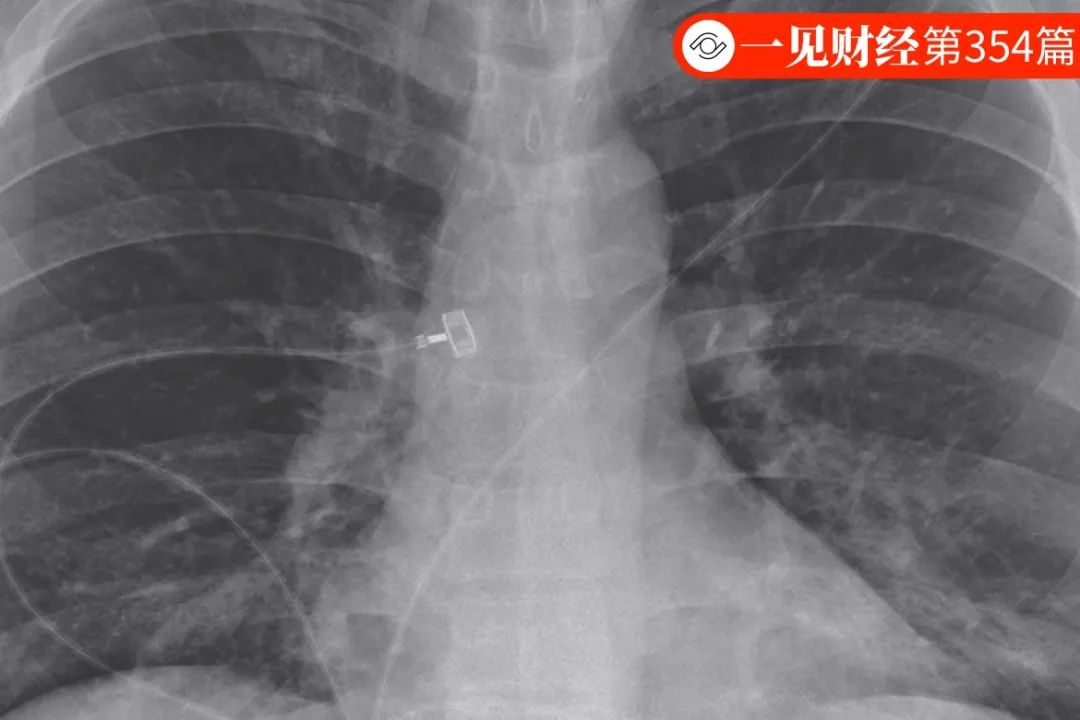 治愈最新肺炎，科学、希望与挑战的交汇点